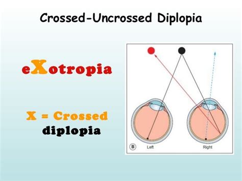 crossed vs uncrossed diplopia.